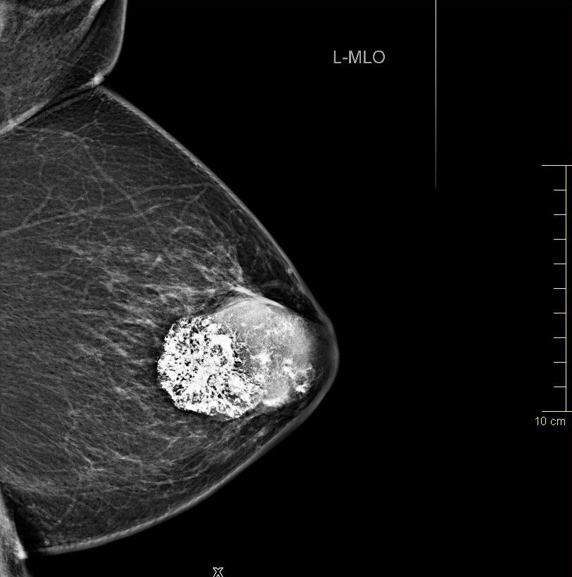 36++ Gutartiger tumor brust bilder , metaplastisches Karzinom der Brust