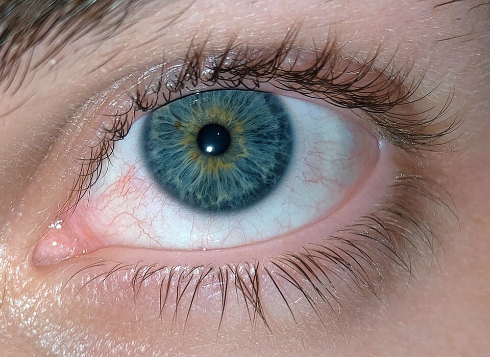 Iris-Hererochromie