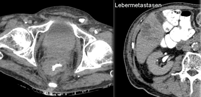 CT Rektum-Ca