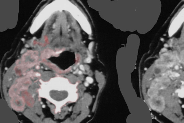 CT Hypopharynx-Ca