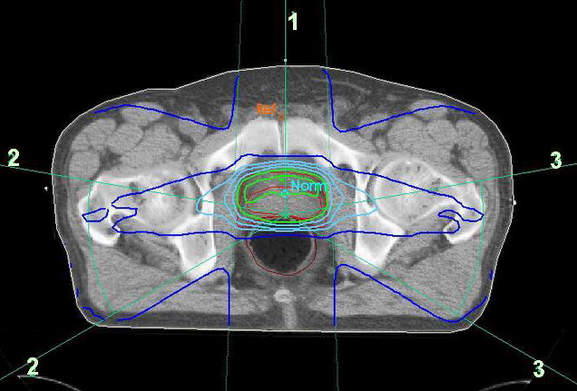Isodosen RT Prostata