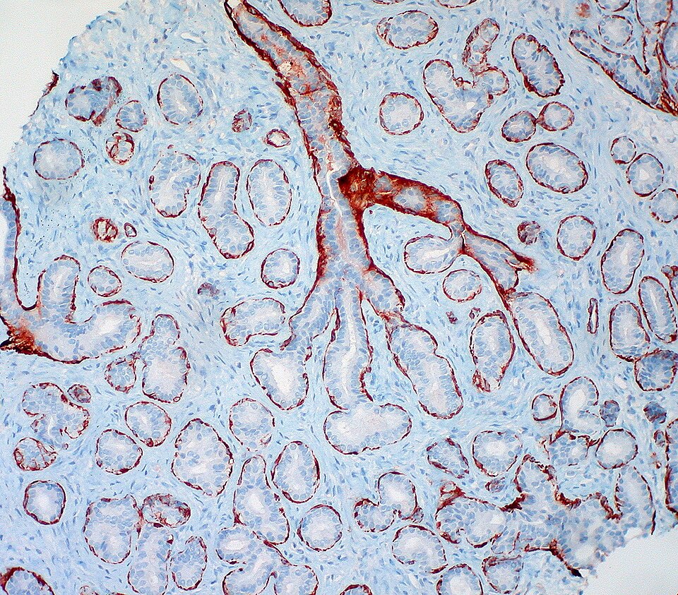 tubuläres Adenom