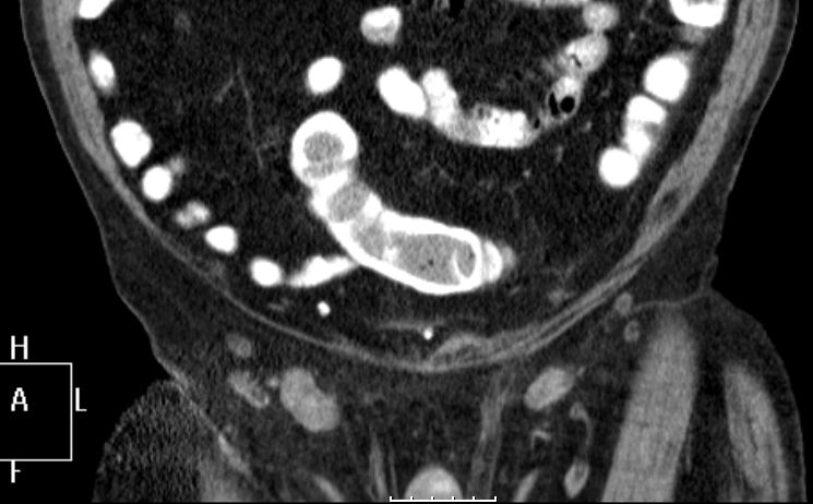 Lymphknotenmetastasen bei Peniskarzinom