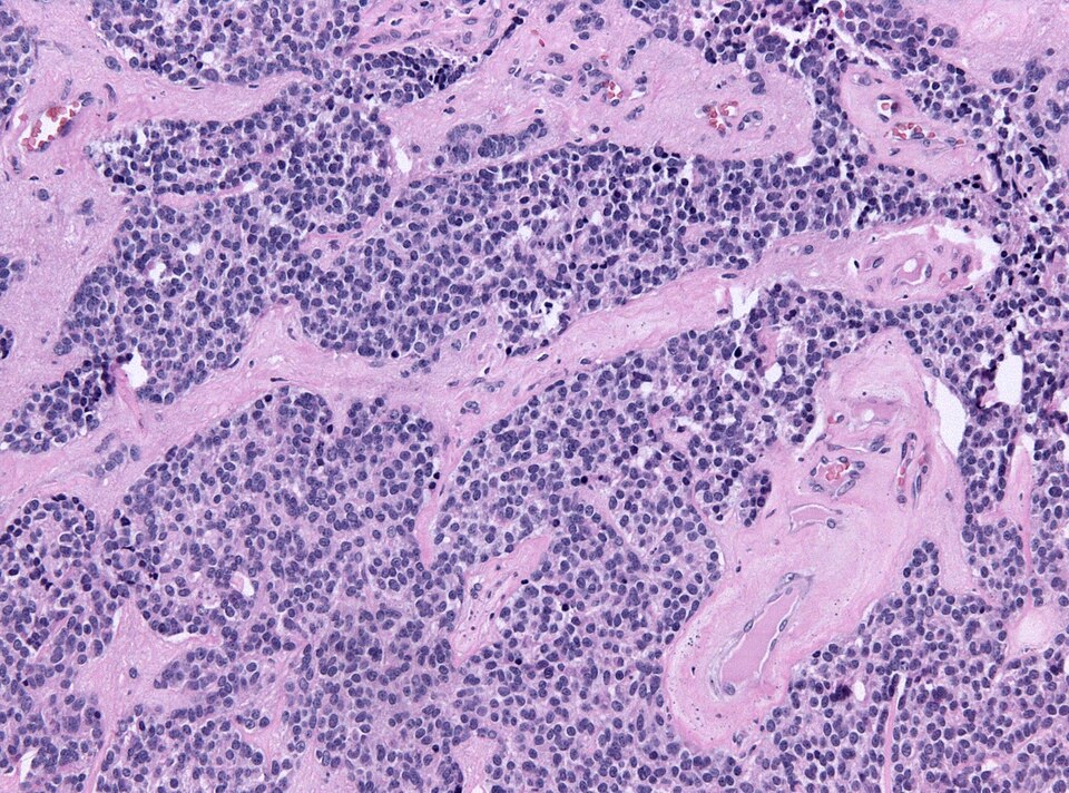 Neuroblastom